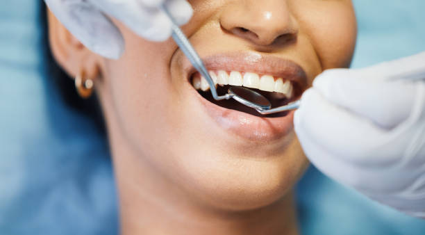 Best Emergency Wisdom Tooth Extraction in Sonoma, CA